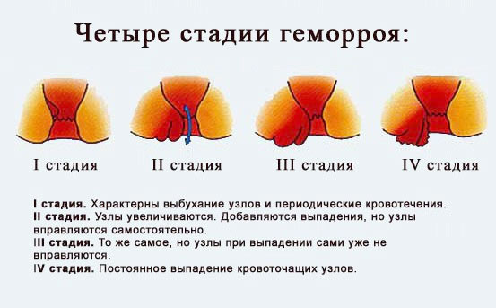 лечение геморроя Обнинск