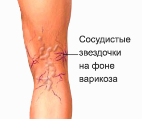 Сосудистые звездочки Обнинск лечение