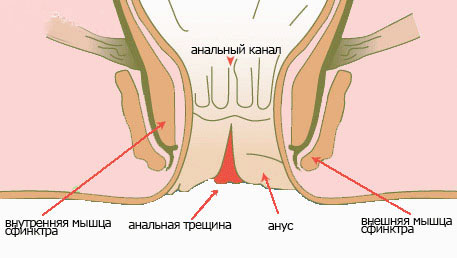 Анальная трещина Обнинск